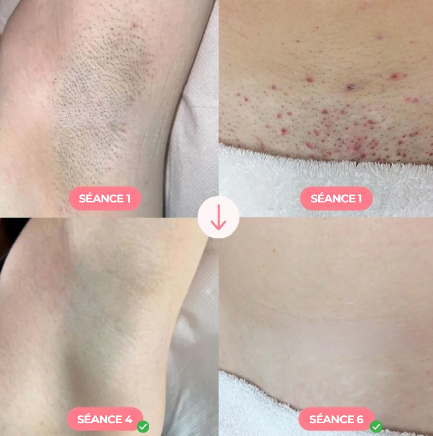 EvoGleam – Épilateur IPL Professionnel à Domicile